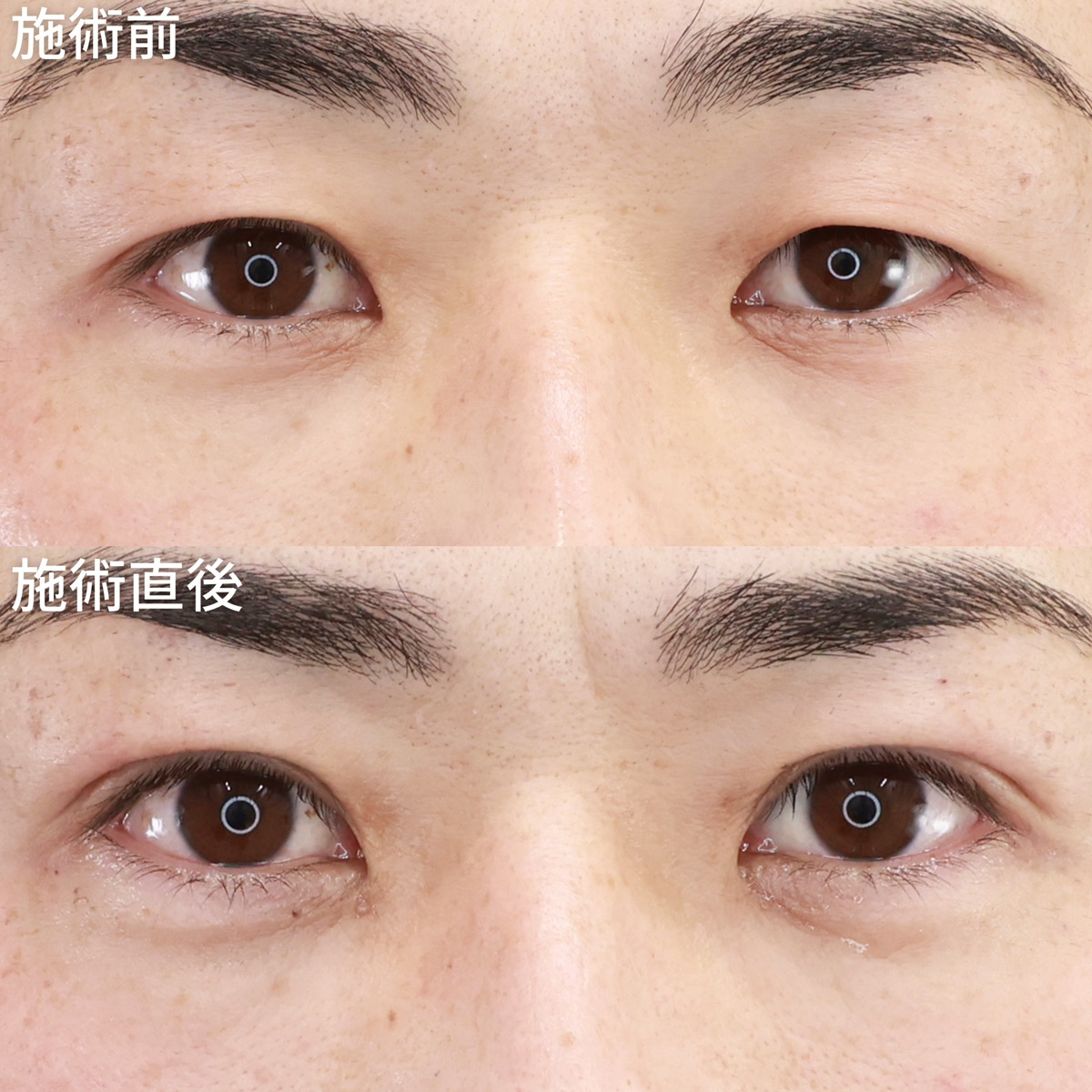 【ばれにくいメンズ二重埋没法】直後から目力アップ！1ヵ月の経過もご紹介！