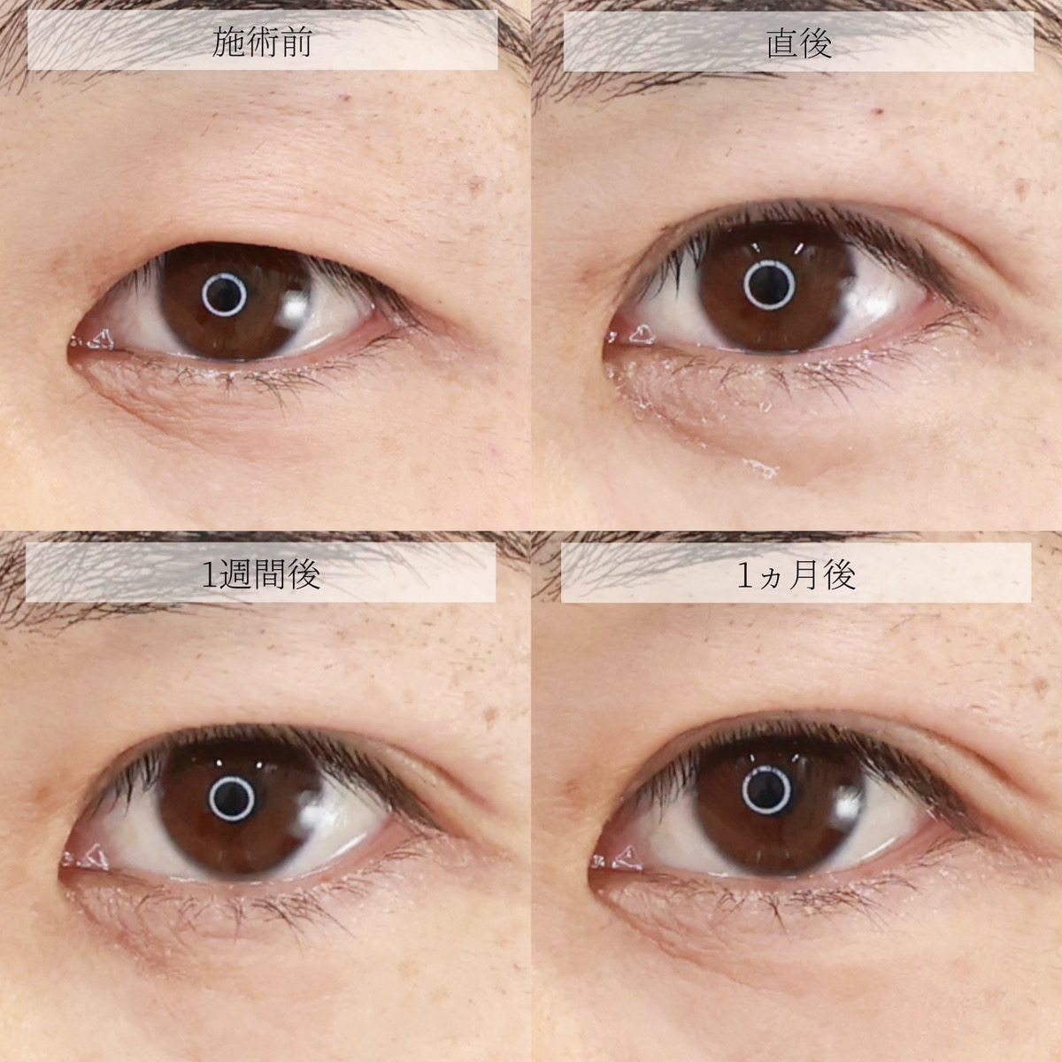 クイックコスメリングの症例写真 施術前後 