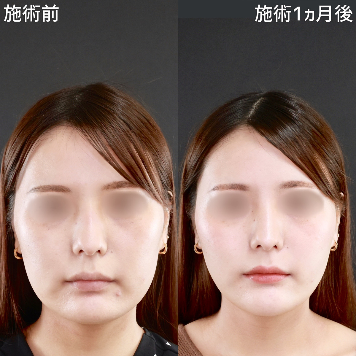 【パーフェクトフェイスライン】四角い輪郭を卵型に整える！