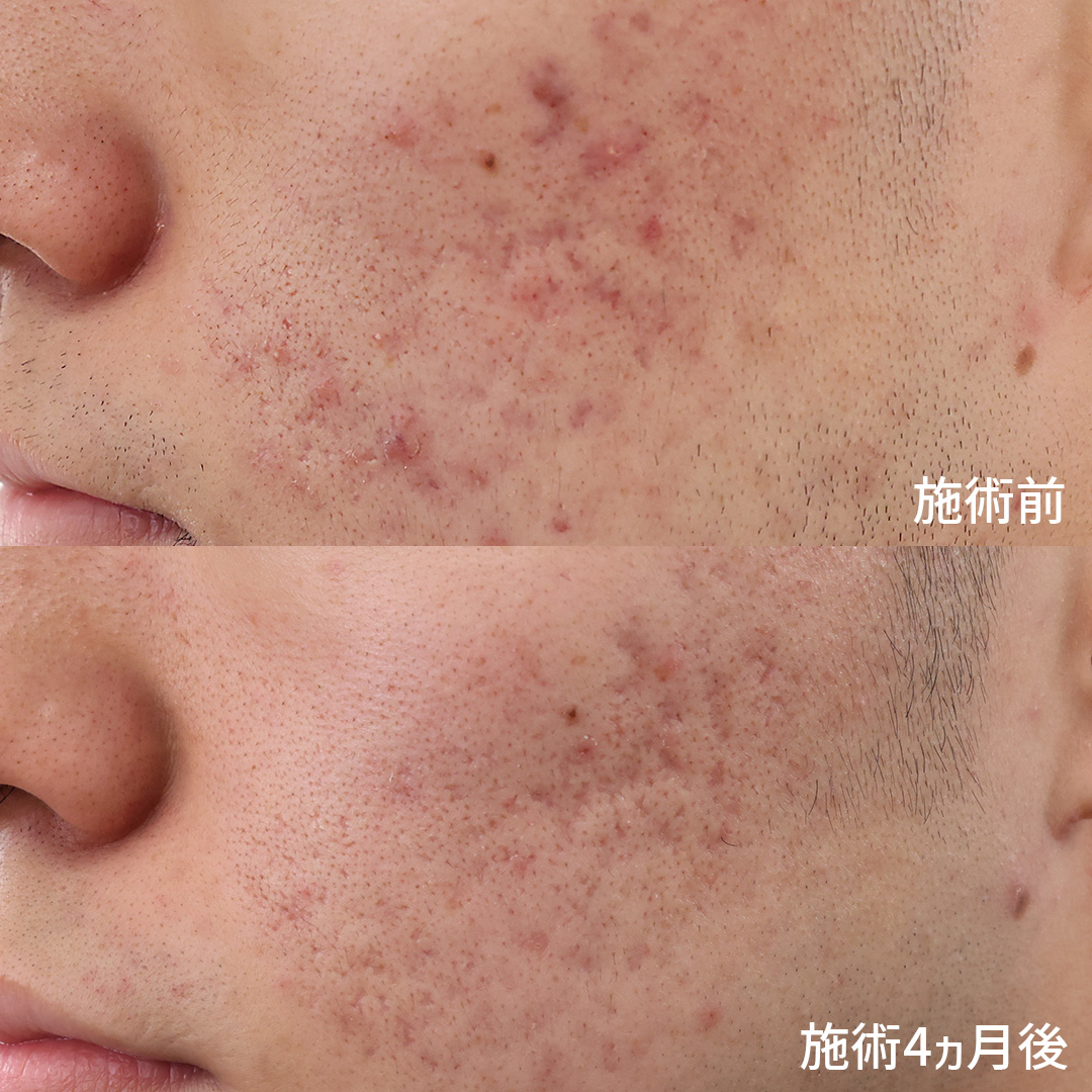 ヴァンパイアフェイシャルの症例写真 施術前後