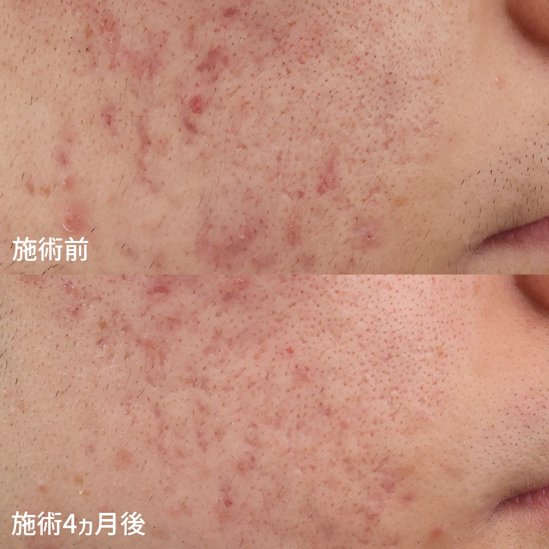 ヴァンパイアフェイシャルの症例写真 施術前後