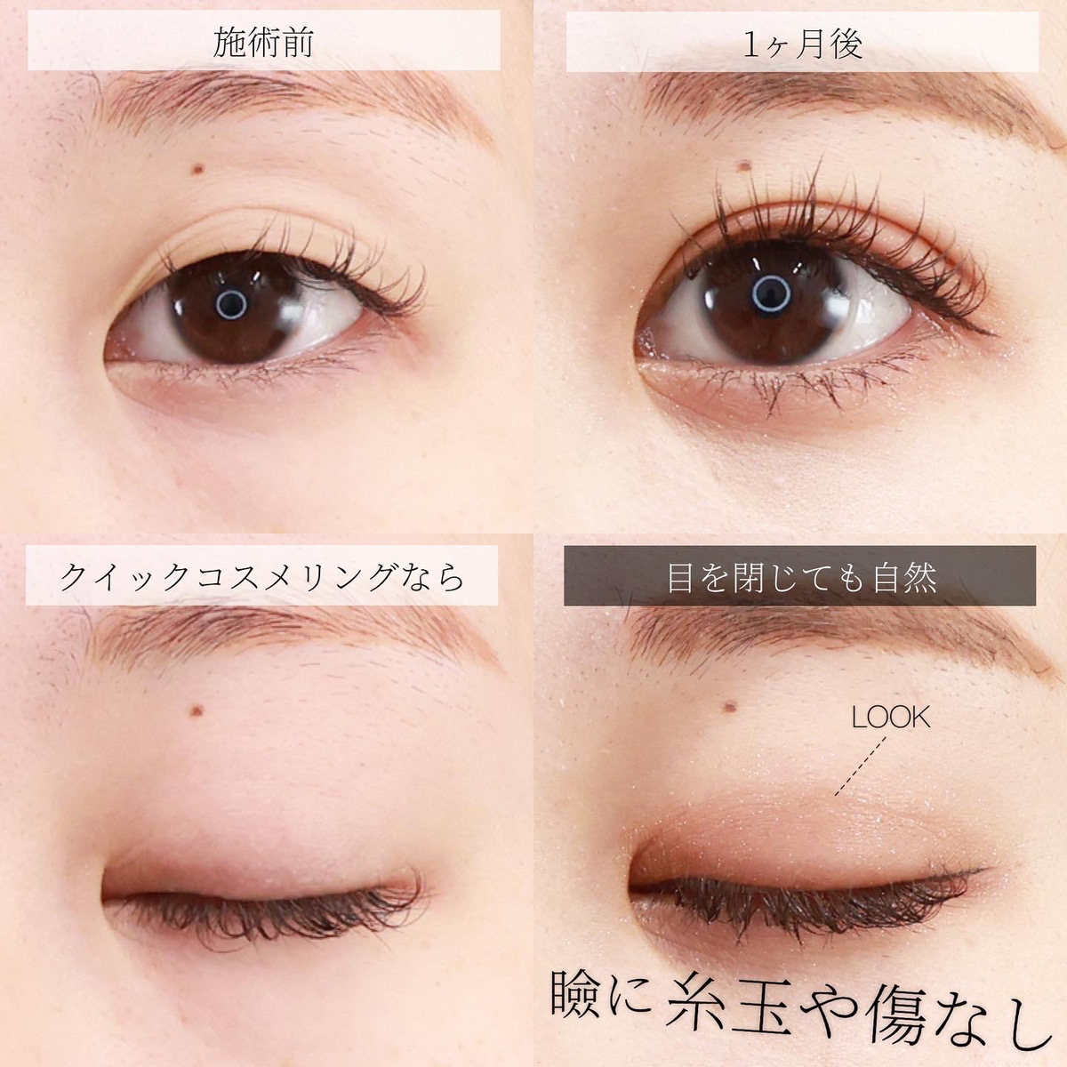 クイックコスメリング/下眼瞼切開術（クマ・たるみとり）の症例写真 施術前後 