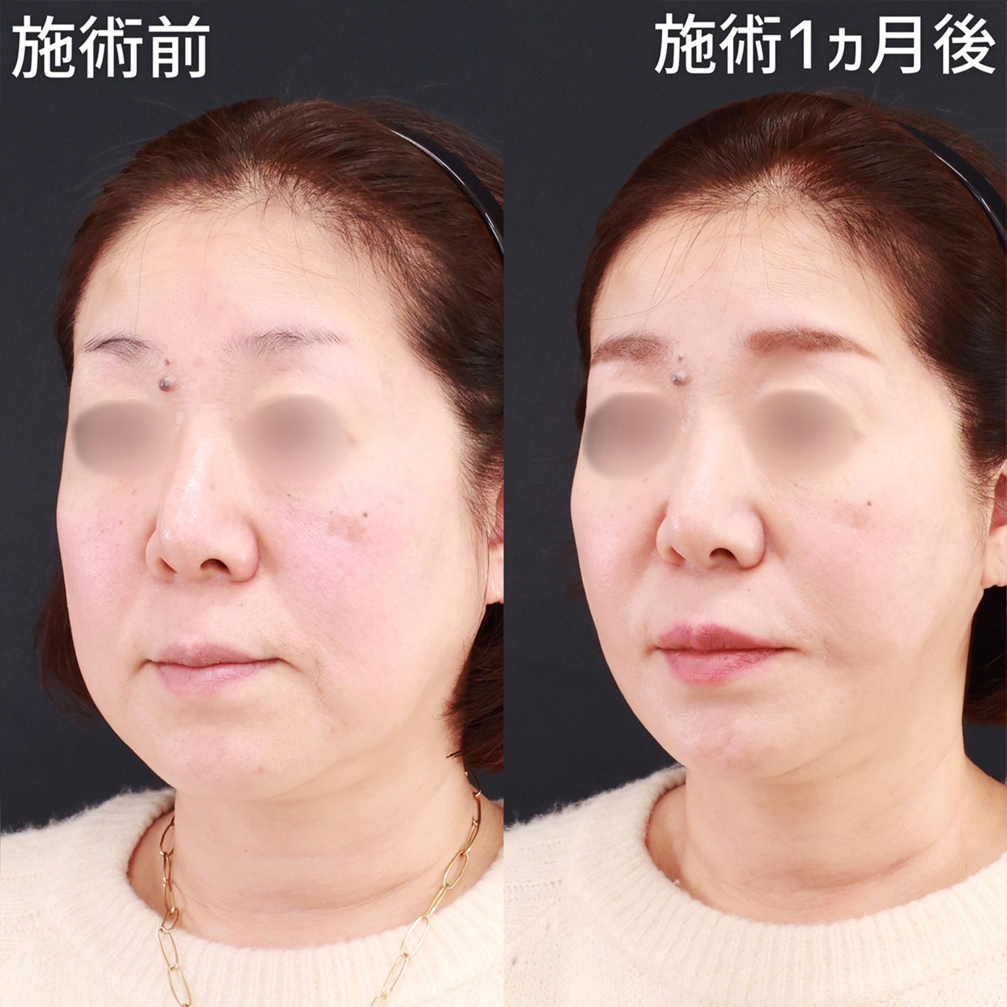 【糸リフト&脂肪吸引】スッキリ可愛く！自然なアンチエイジングならお任せください。