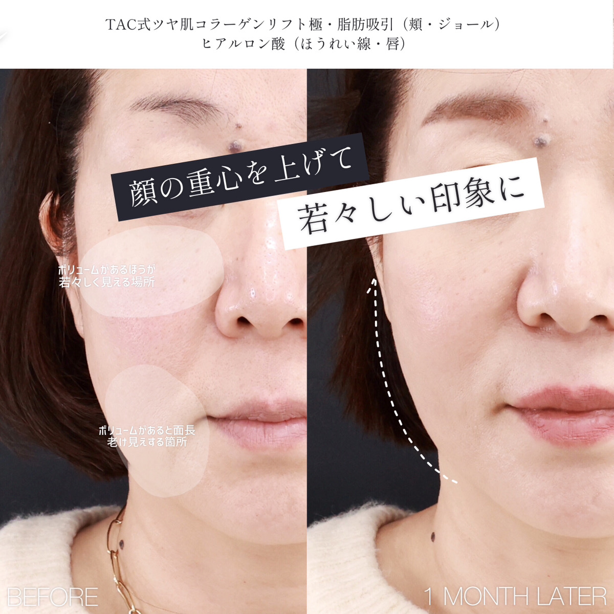 TAC式 ツヤ肌コラーゲンリフト®/ジョールファット除去/顎下の脂肪吸引の症例写真 施術前後 
