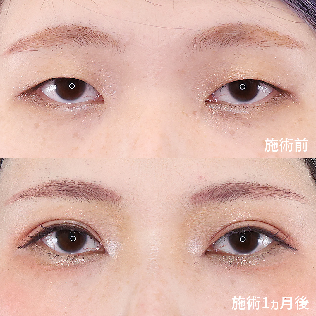 印象的かつ自然な仕上がり。【二重埋没法】でつくる平行型二重。