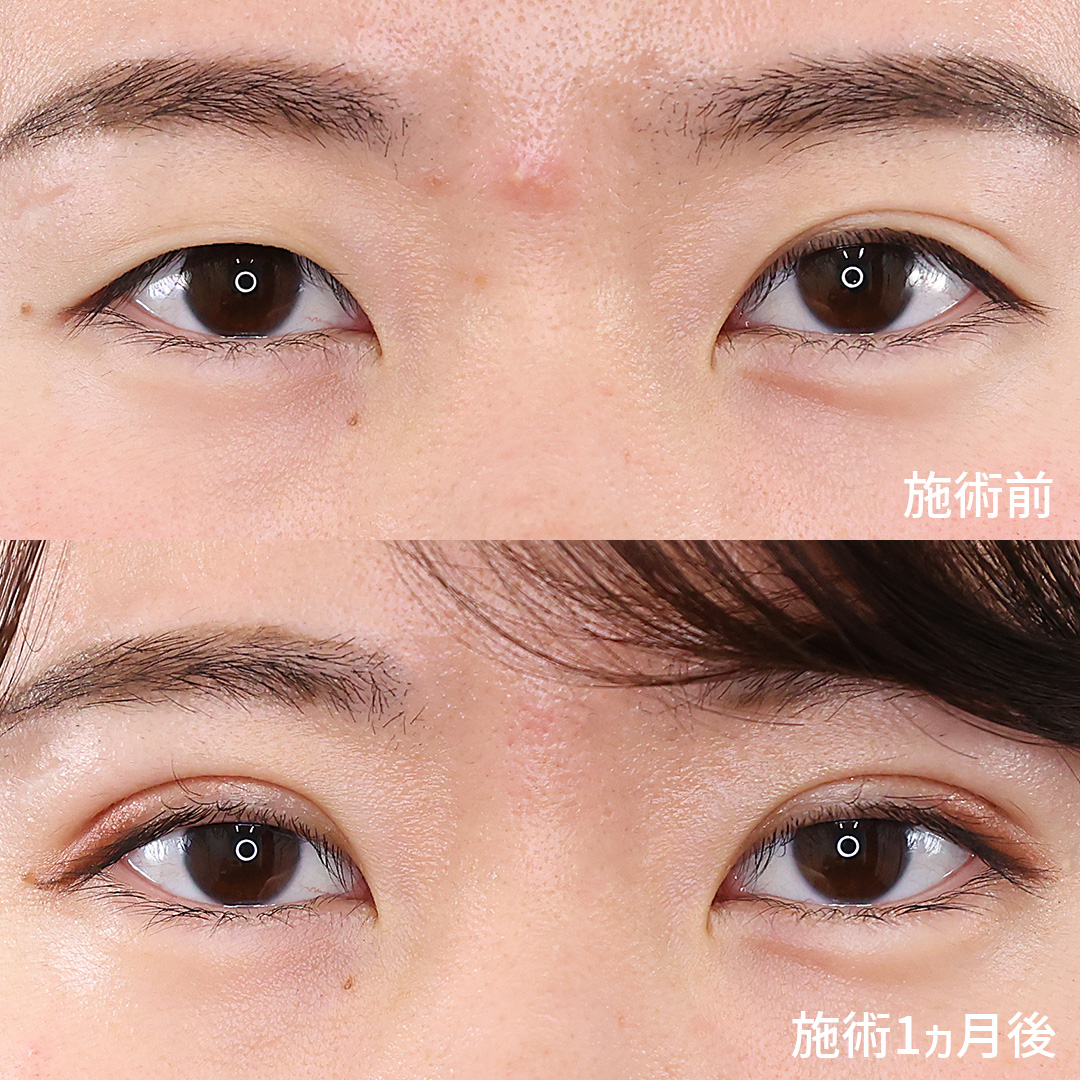 TAクリニックの【二重埋没法】で、左右差のある目元を最短で改善