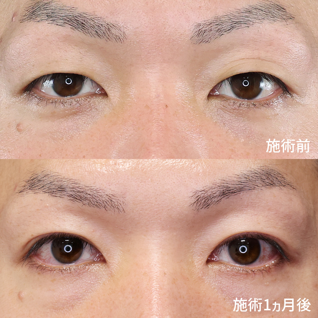 断然自然な仕上がりの二重埋没法！【クイックコスメリング】