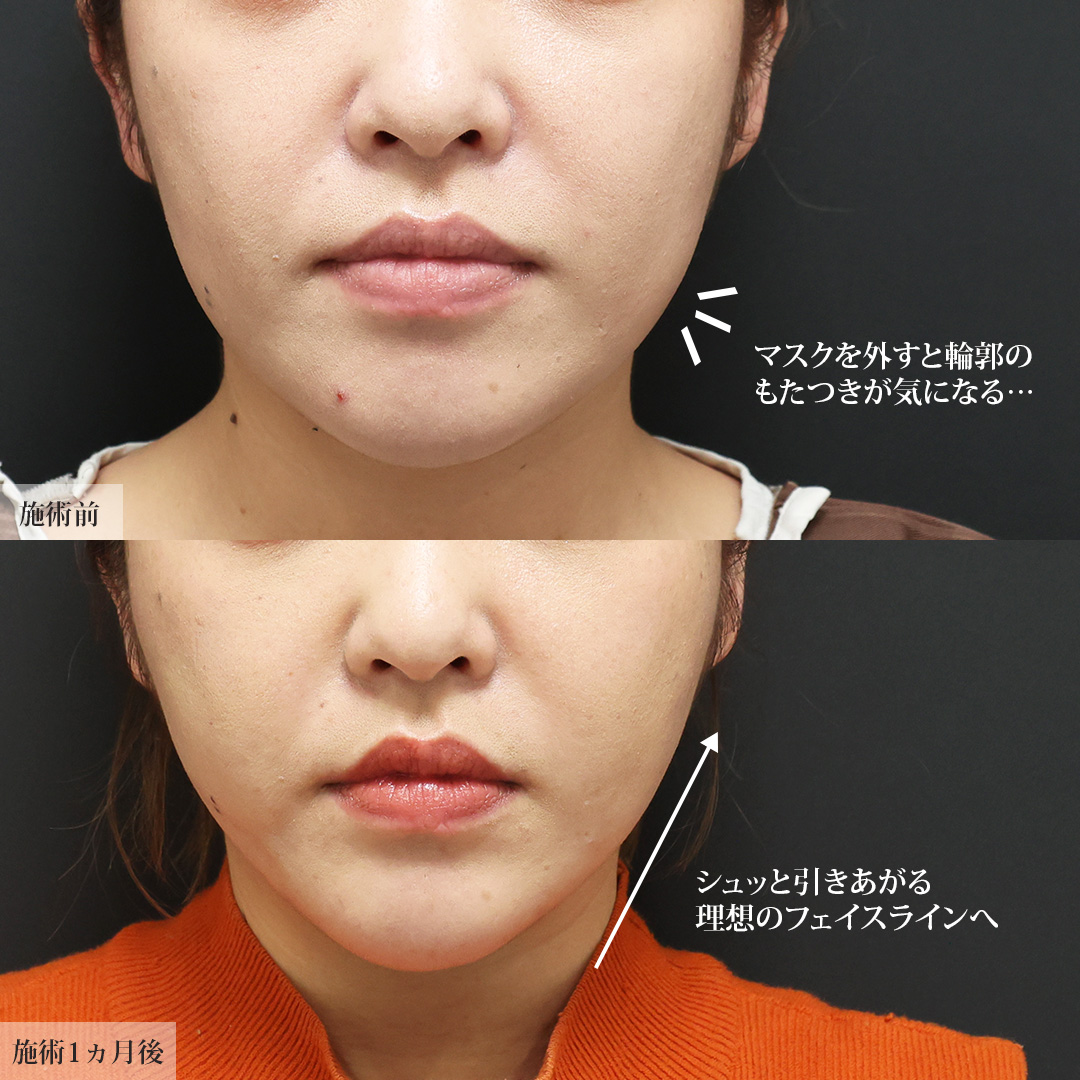 TAC式 ツヤ肌コラーゲンリフト®/バッカルファット除去/ジョールファット除去の症例写真 施術前後 