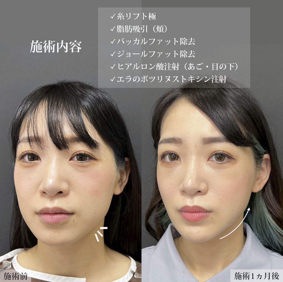 TAC式 ツヤ肌コラーゲンリフト®/バッカルファット除去/ジョールファット除去の症例写真 施術前後 