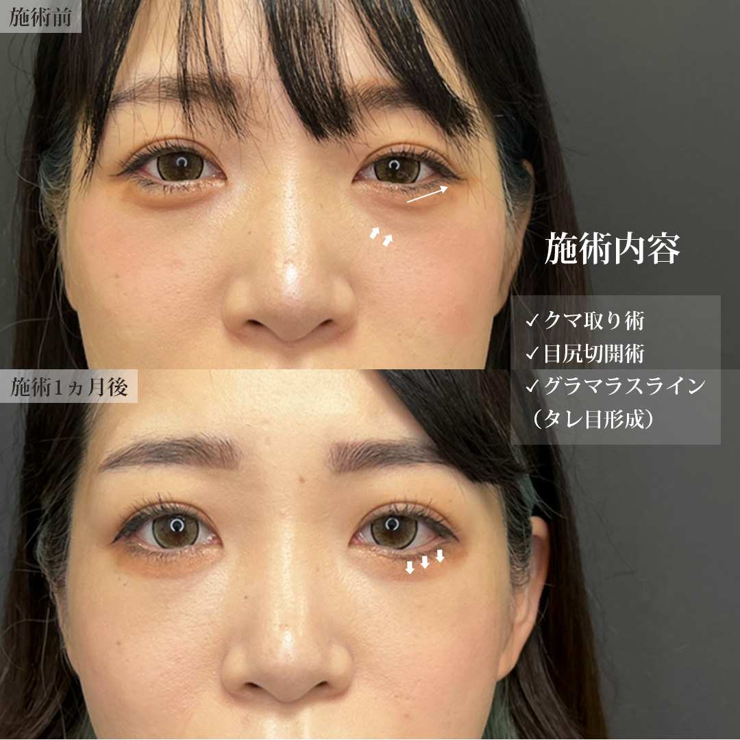 TAC式 ツヤ肌コラーゲンリフト®/バッカルファット除去/ジョールファット除去の症例写真 施術前後 