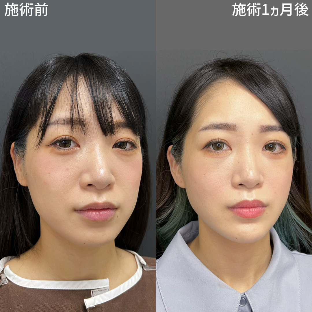 TAC式 ツヤ肌コラーゲンリフト®/バッカルファット除去/ジョールファット除去の症例写真 施術前後 