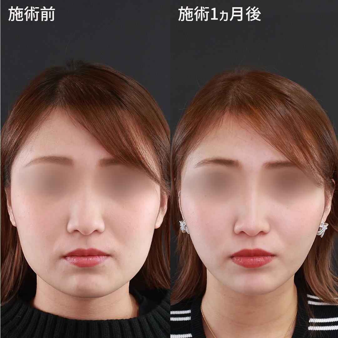 【TAC式 ツヤ肌コラーゲンリフト®極】と【脂肪除去】でお顔のたるみを一気に解消！