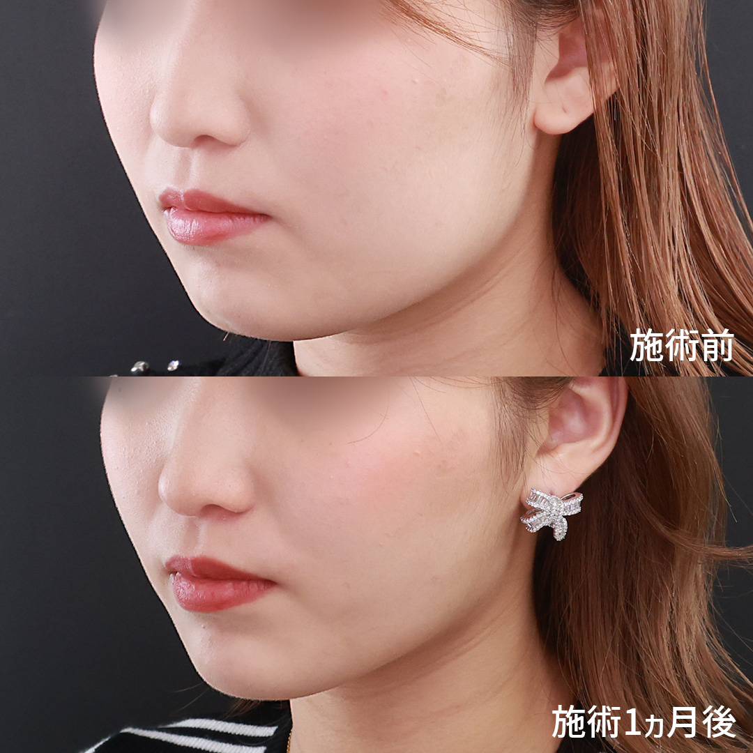 TAC式 ツヤ肌コラーゲンリフト®/ジョールファット除去/顔の脂肪吸引の症例写真 施術前後 