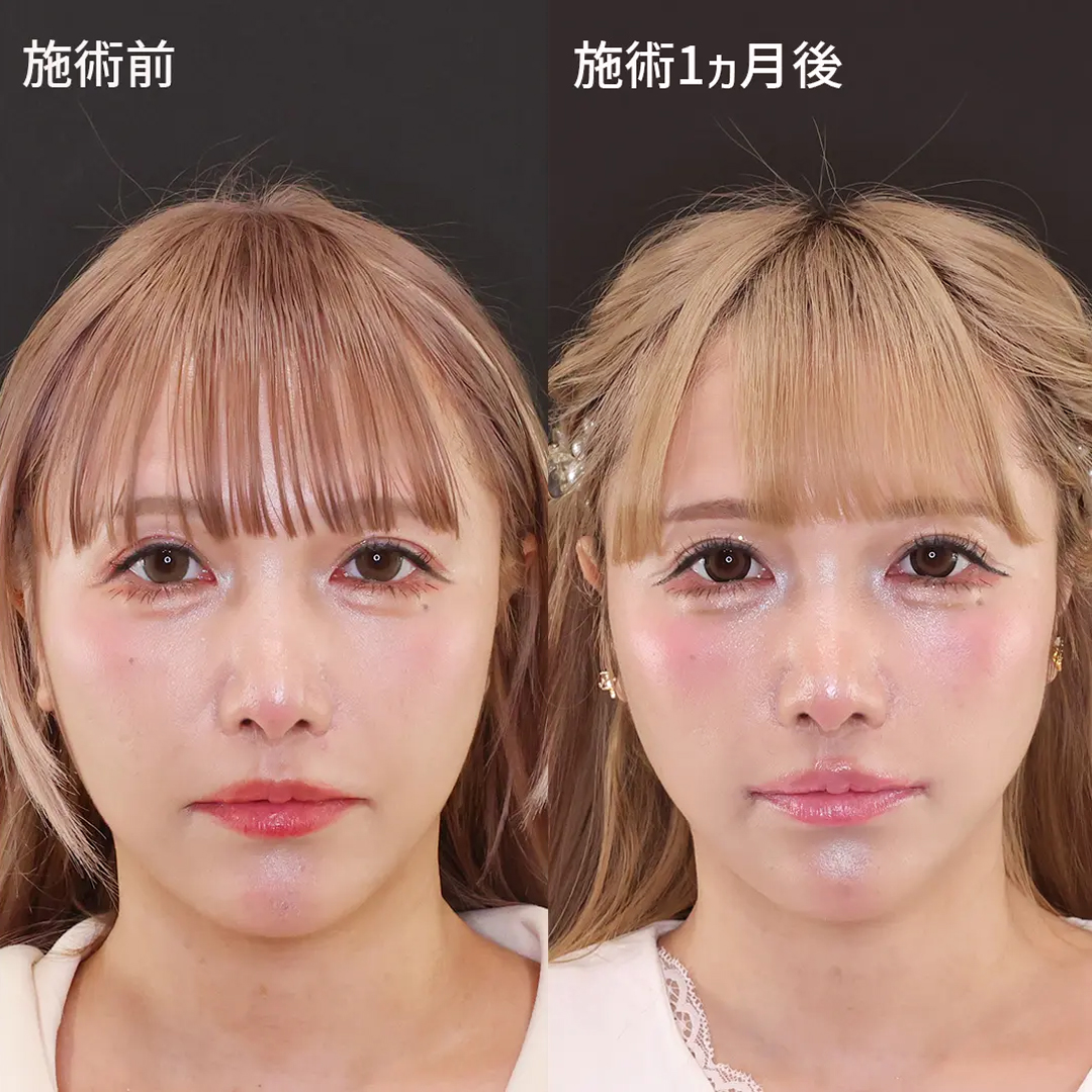 更に可愛いベビーフェイスに！【糸リフト×口角挙上】