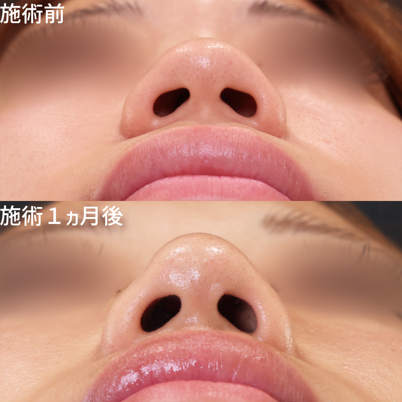 切開ナシでもここまで変わる！切らない鼻尖縮小で団子鼻を解消