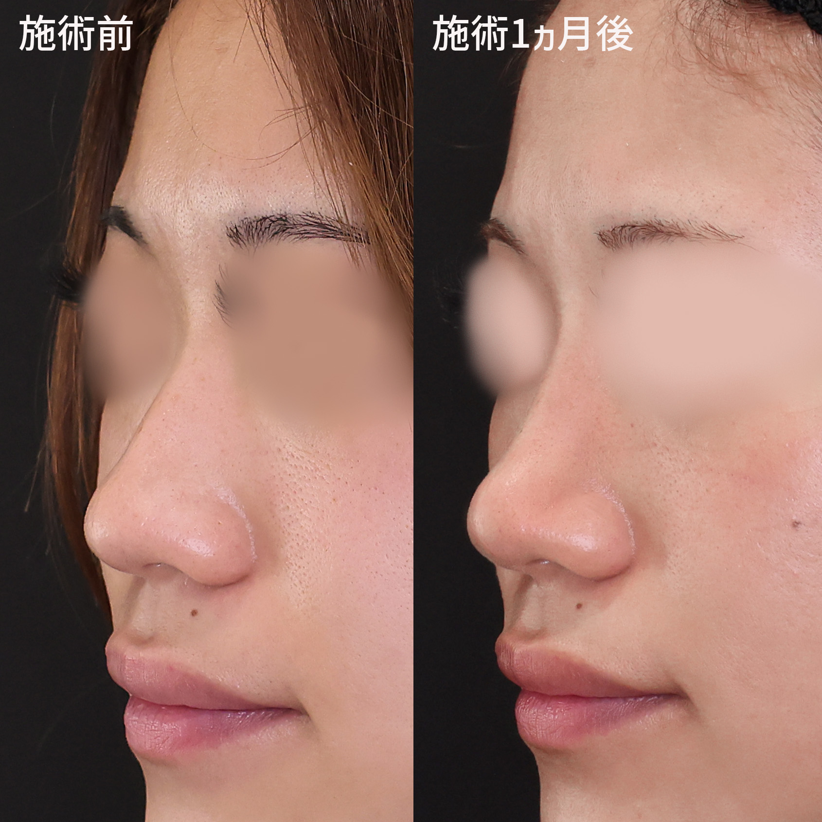 鼻尖形成・鼻尖縮小/鼻のヒアルロン酸注射の症例写真 施術前後 
