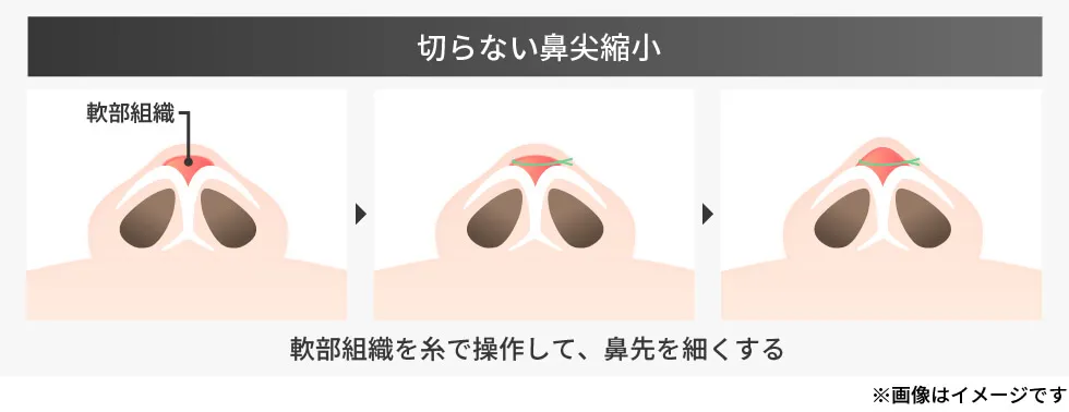 鼻尖形成・鼻尖縮小/鼻のヒアルロン酸注射の症例写真 施術前後 