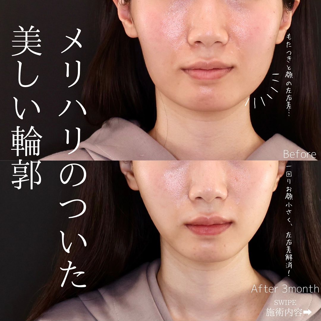 ジョールファット除去/TAC式 ツヤ肌コラーゲンリフト®の症例写真 施術前後 