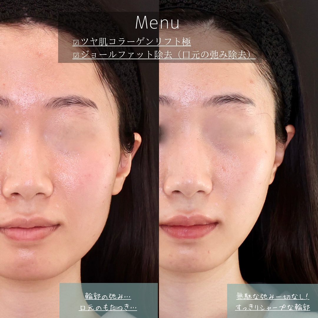 ジョールファット除去/TAC式 ツヤ肌コラーゲンリフト®の症例写真 施術前後 