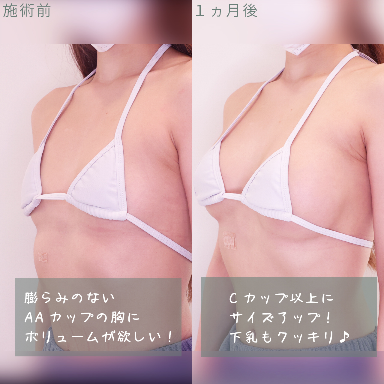 傷跡ほとんど気にならない仕上がり自然なシリコンバッグ豊胸症例写真ビフォーアフター美容整形美容外科のTAクリニックグループ