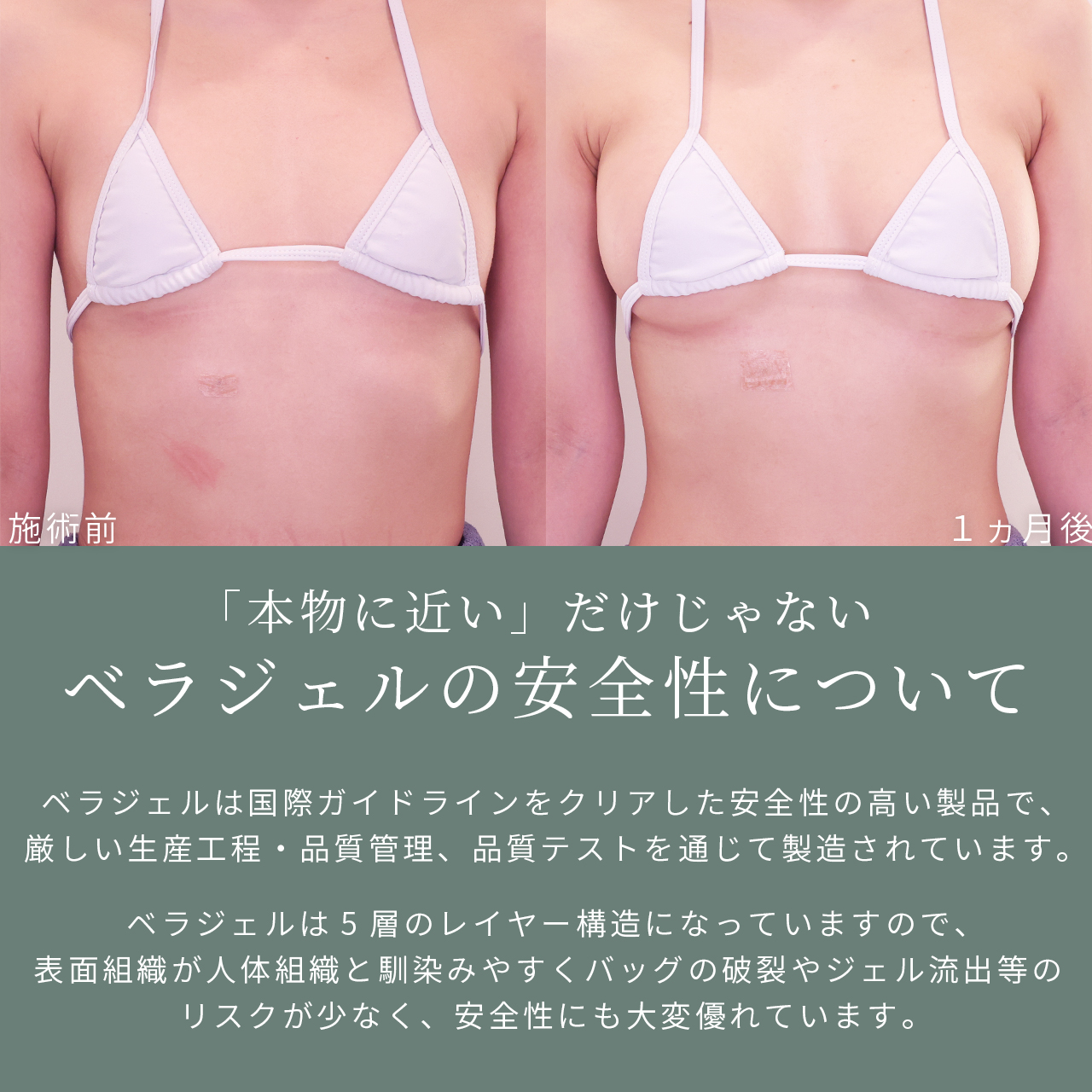 シリコンバッグ豊胸（人工乳腺バッグ）の症例写真 施術前後 