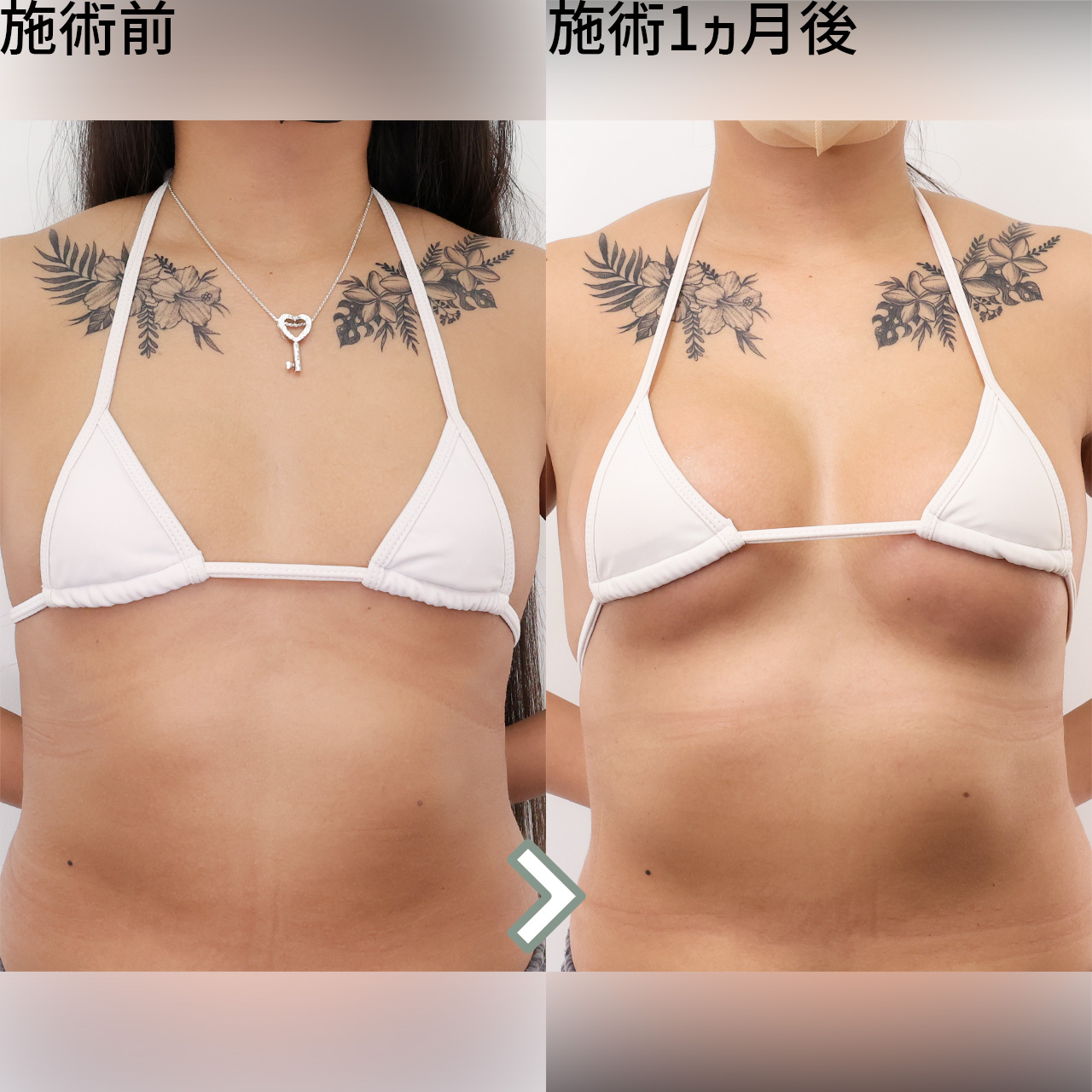 高品質シリコンバッグで美しく豊胸。自然なバストアップを叶える
