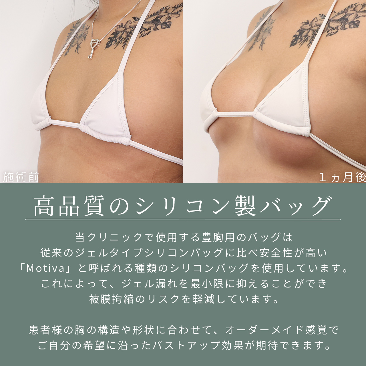 シリコンバッグ豊胸(人工乳腺バッグ)の症例写真 施術前後