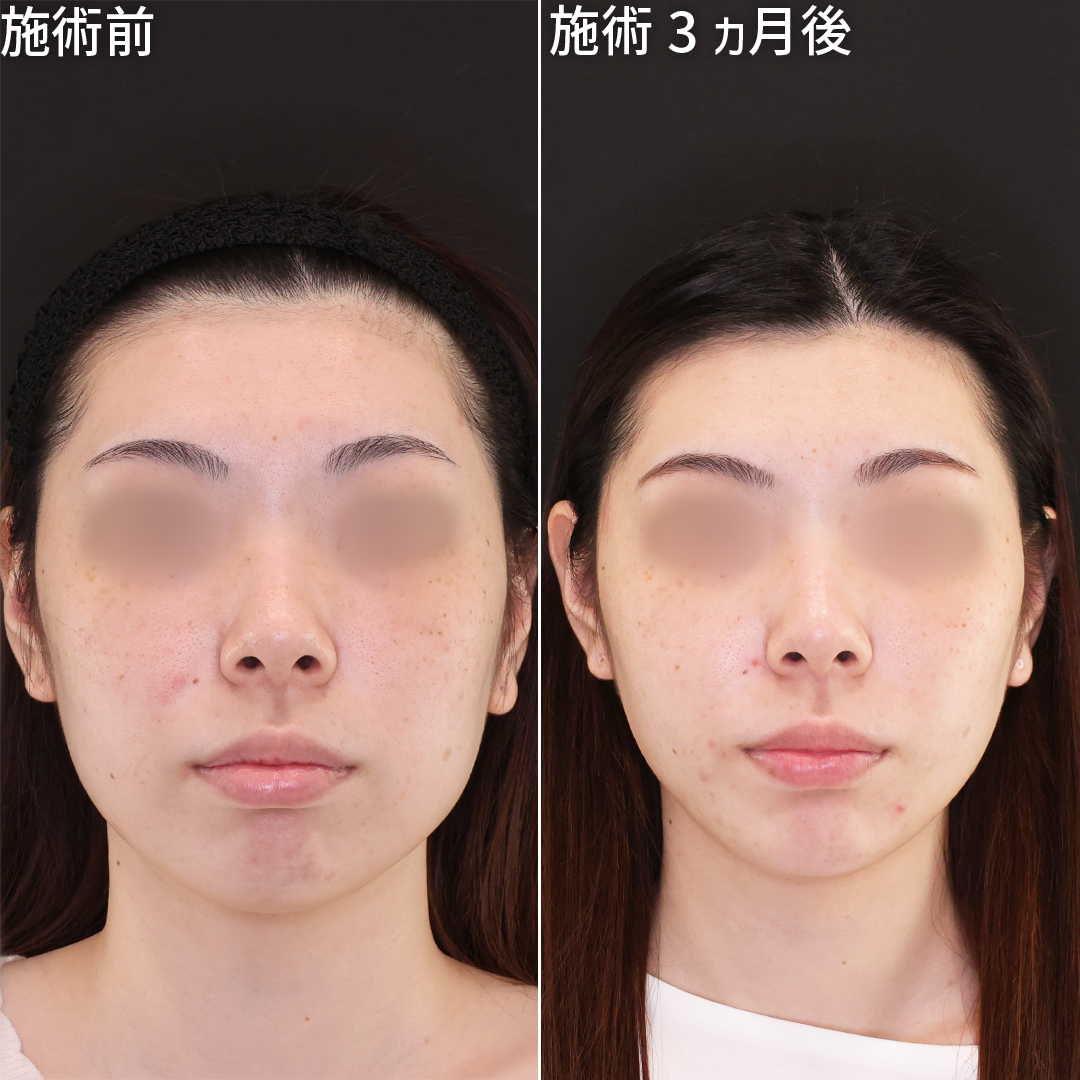 骨切りなしで小顔は叶う!30分の施術で顔痩せ