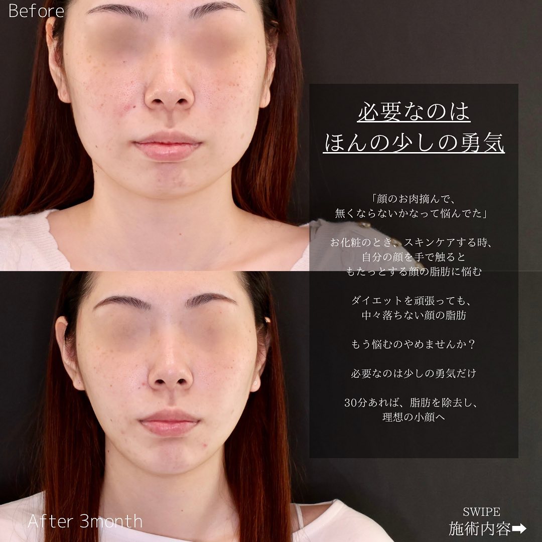 TAC式 ツヤ肌コラーゲンリフト®/顔の脂肪吸引/顎のヒアルロン酸注射の症例写真 施術前後 