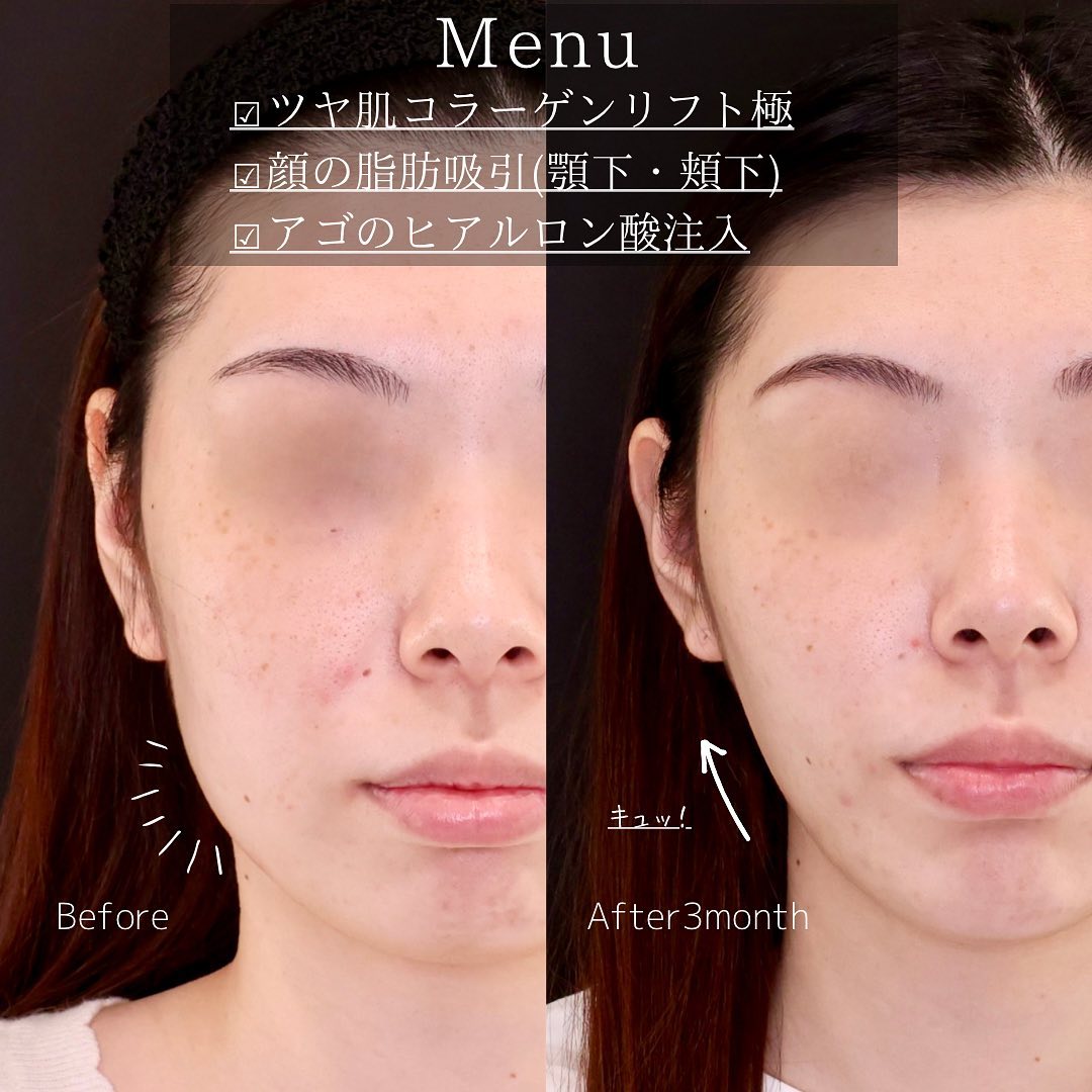 TAC式 ツヤ肌コラーゲンリフト®/顔の脂肪吸引/顎のヒアルロン酸注射の症例写真 施術前後 