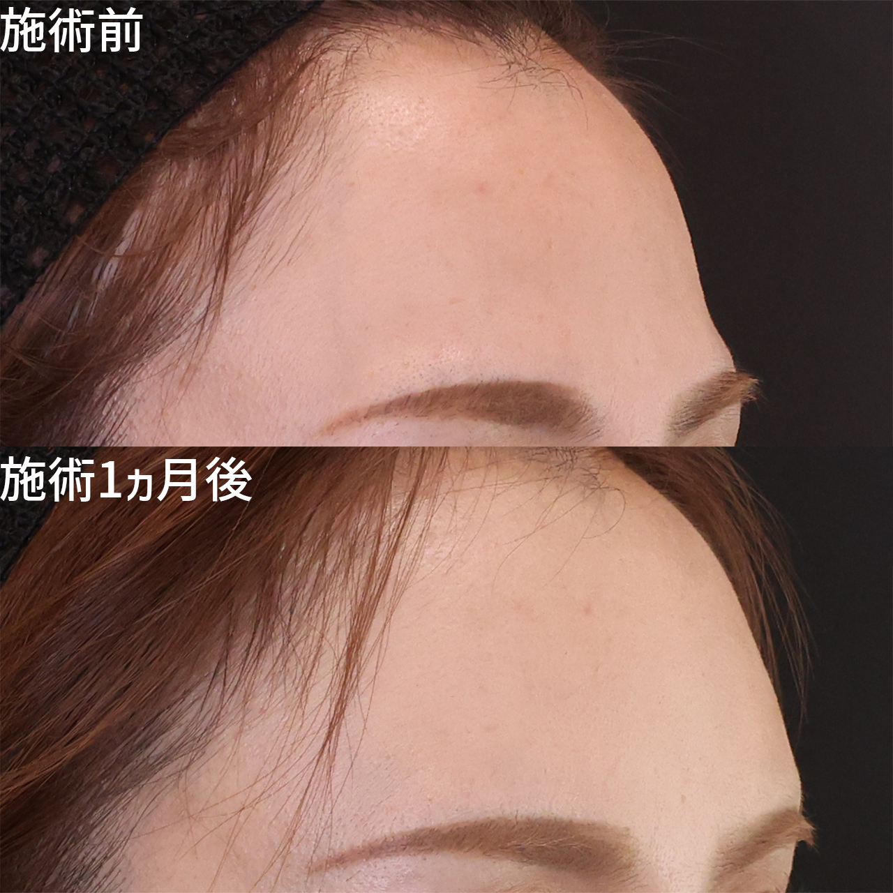 気になる段差・凹凸をなくす。脂肪注入で自然な美おでこ