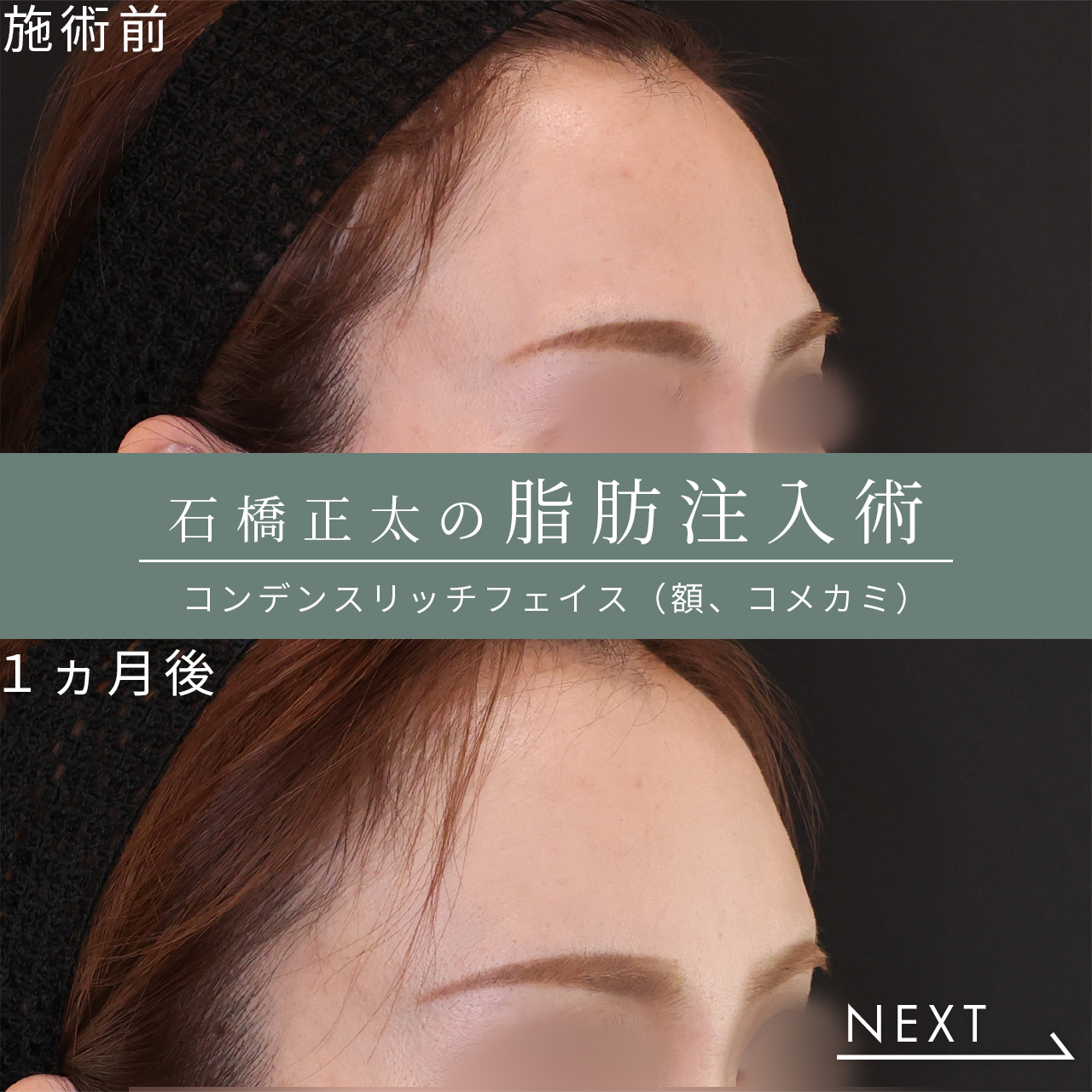 顔の脂肪注入(コンデンスリッチフェイス)の症例写真 施術前後