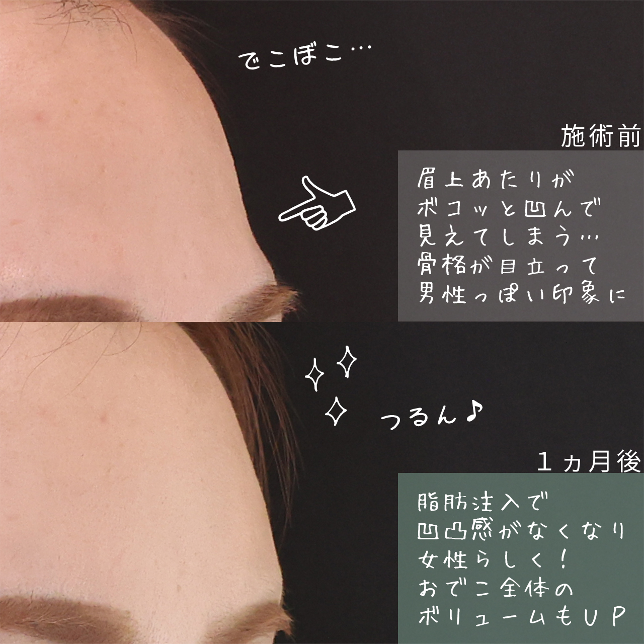 顔の脂肪注入(コンデンスリッチフェイス)の症例写真 施術前後