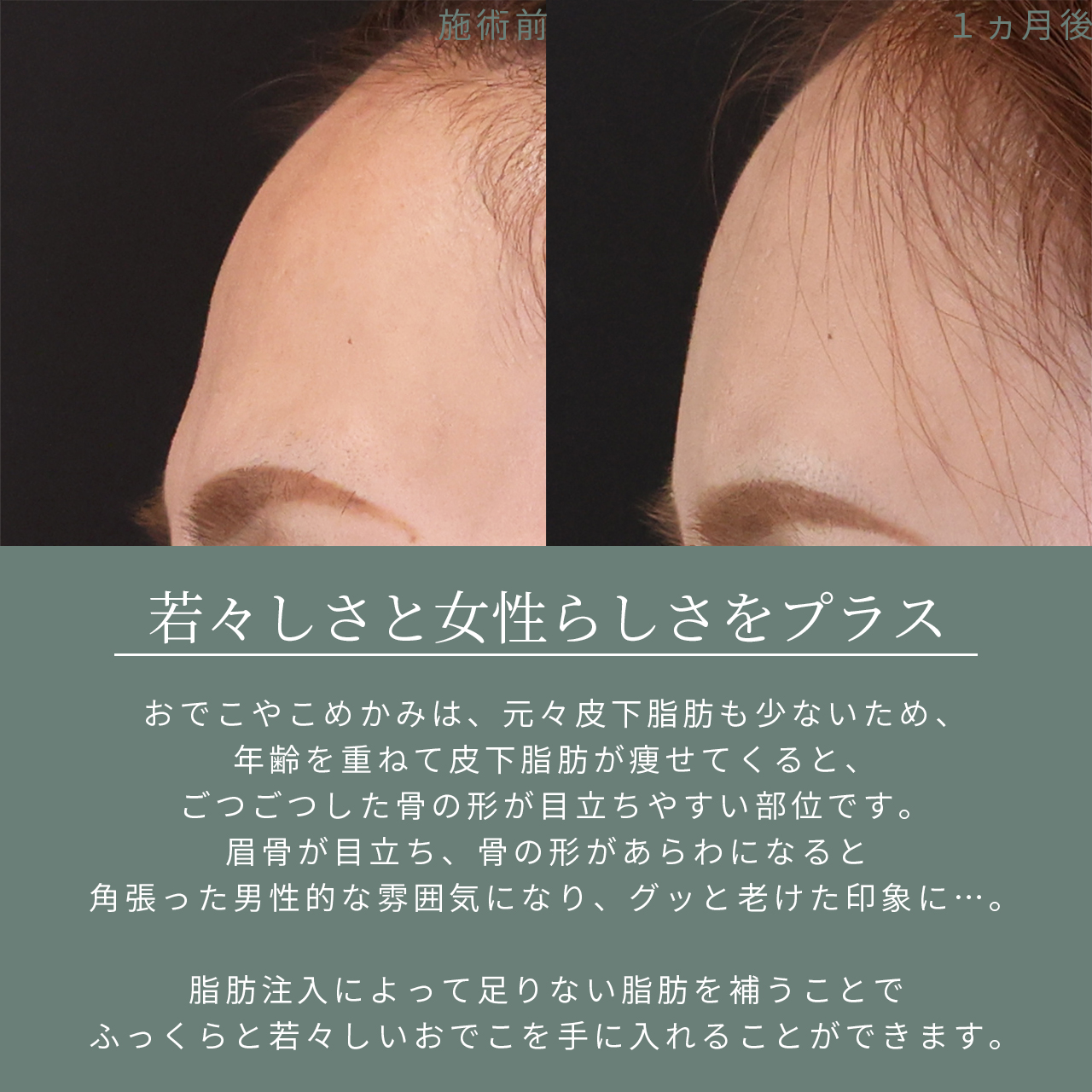 顔の脂肪注入(コンデンスリッチフェイス)の症例写真 施術前後