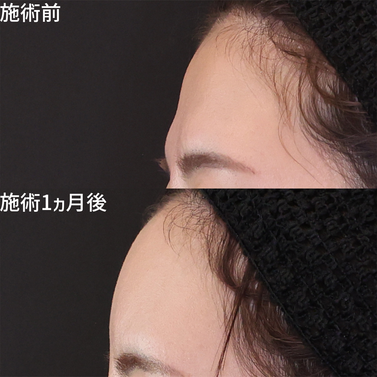 顔の脂肪注入(コンデンスリッチフェイス)の症例写真 施術前後