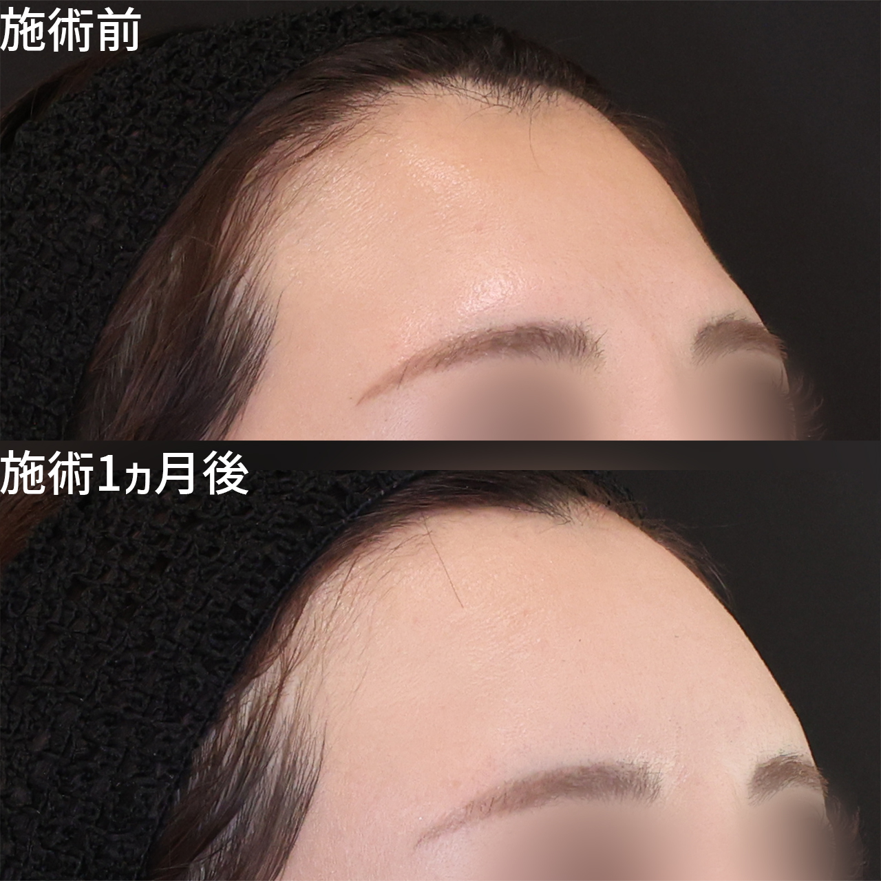 顔の脂肪注入(コンデンスリッチフェイス)の症例写真 施術前後