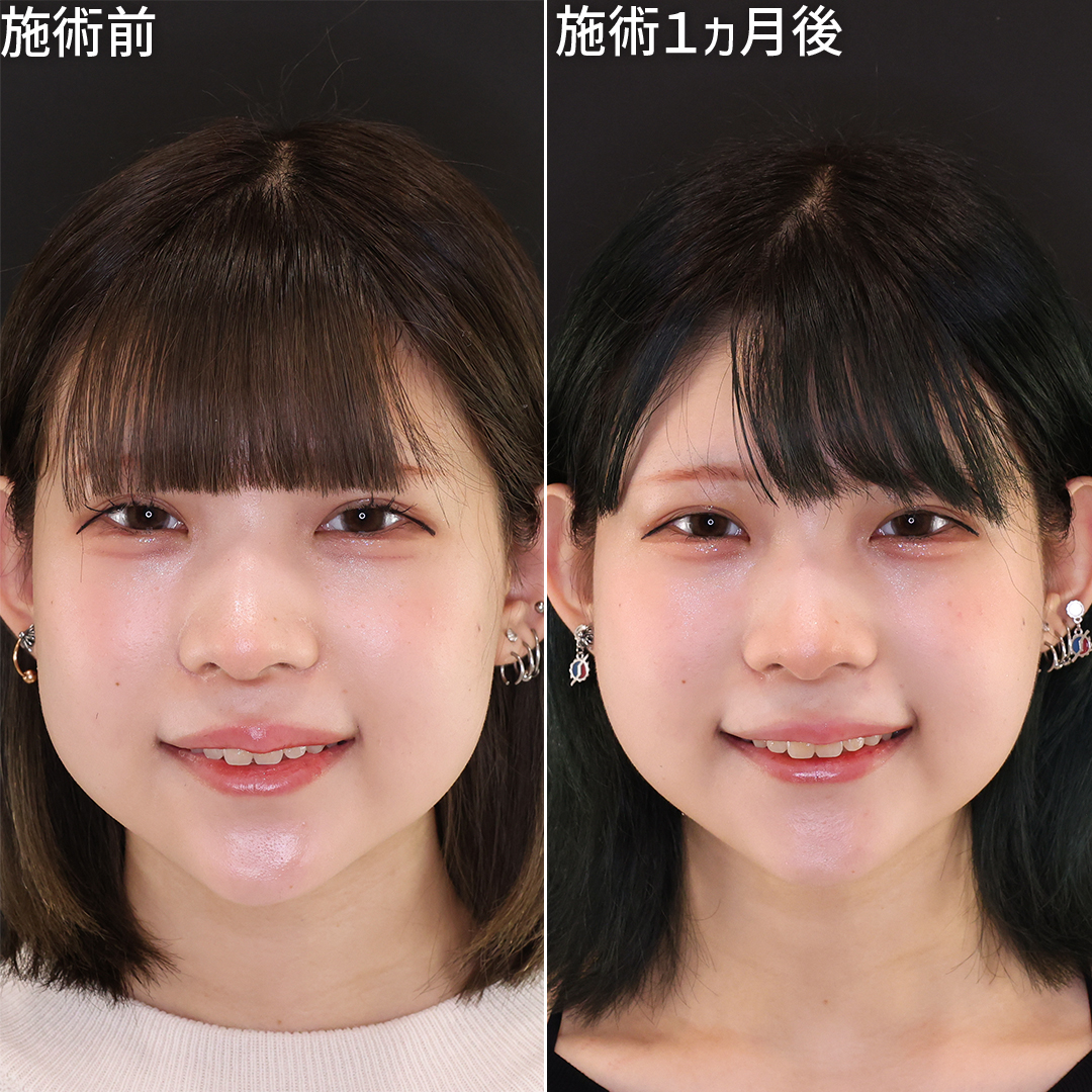 自信が持てる笑顔に大変身！【糸リフト×バッカルファット除去】