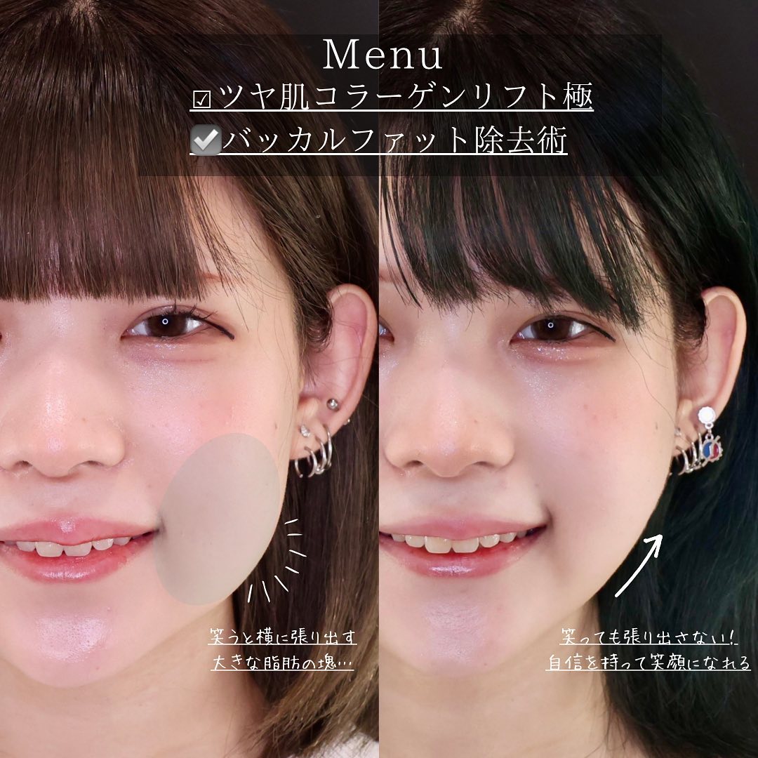 バッカルファット除去/TAC式 ツヤ肌コラーゲンリフト®/顎のヒアルロン酸注射の症例写真 施術前後 