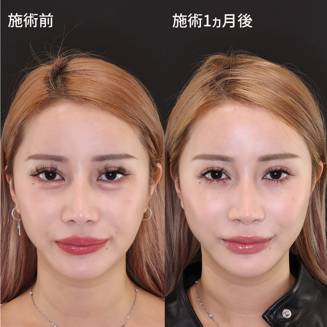 小顔の極限！【糸リフト×アゴヒアルロン酸注入×エラボトックス】