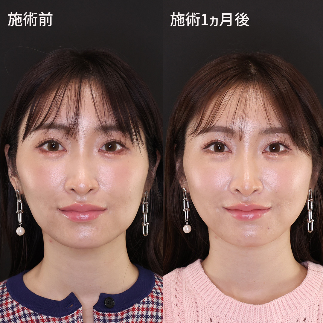 無加工で映える輪郭！【糸リフト】