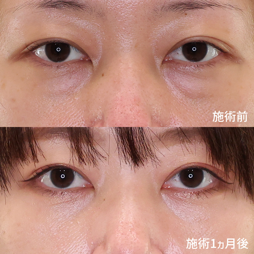 下眼瞼脱脂術(目の下のたるみ取り・目の下の脂肪ふくらみ取り)の症例写真 施術前後