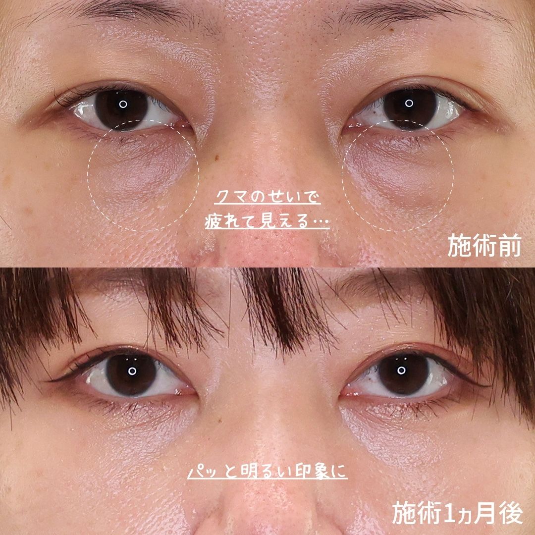 下眼瞼脱脂術(目の下のたるみ取り・目の下の脂肪ふくらみ取り)の症例写真 施術前後