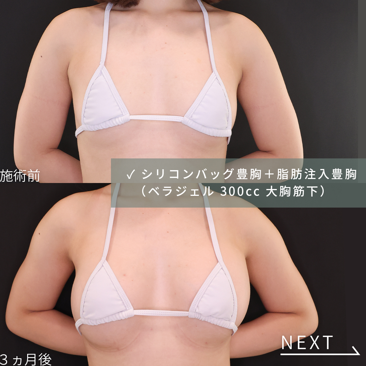 シリコンバッグ豊胸（人工乳腺バッグ）/脂肪注入豊胸（コンデンスリッチ・ピュアグラフト・１day脂肪豊胸）の症例写真 施術前後 