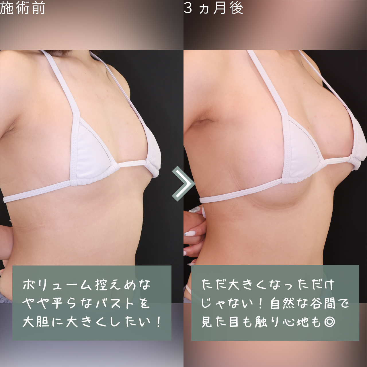 シリコンバッグ豊胸（人工乳腺バッグ）/脂肪注入豊胸（コンデンスリッチ・ピュアグラフト・１day脂肪豊胸）の症例写真 施術前後 