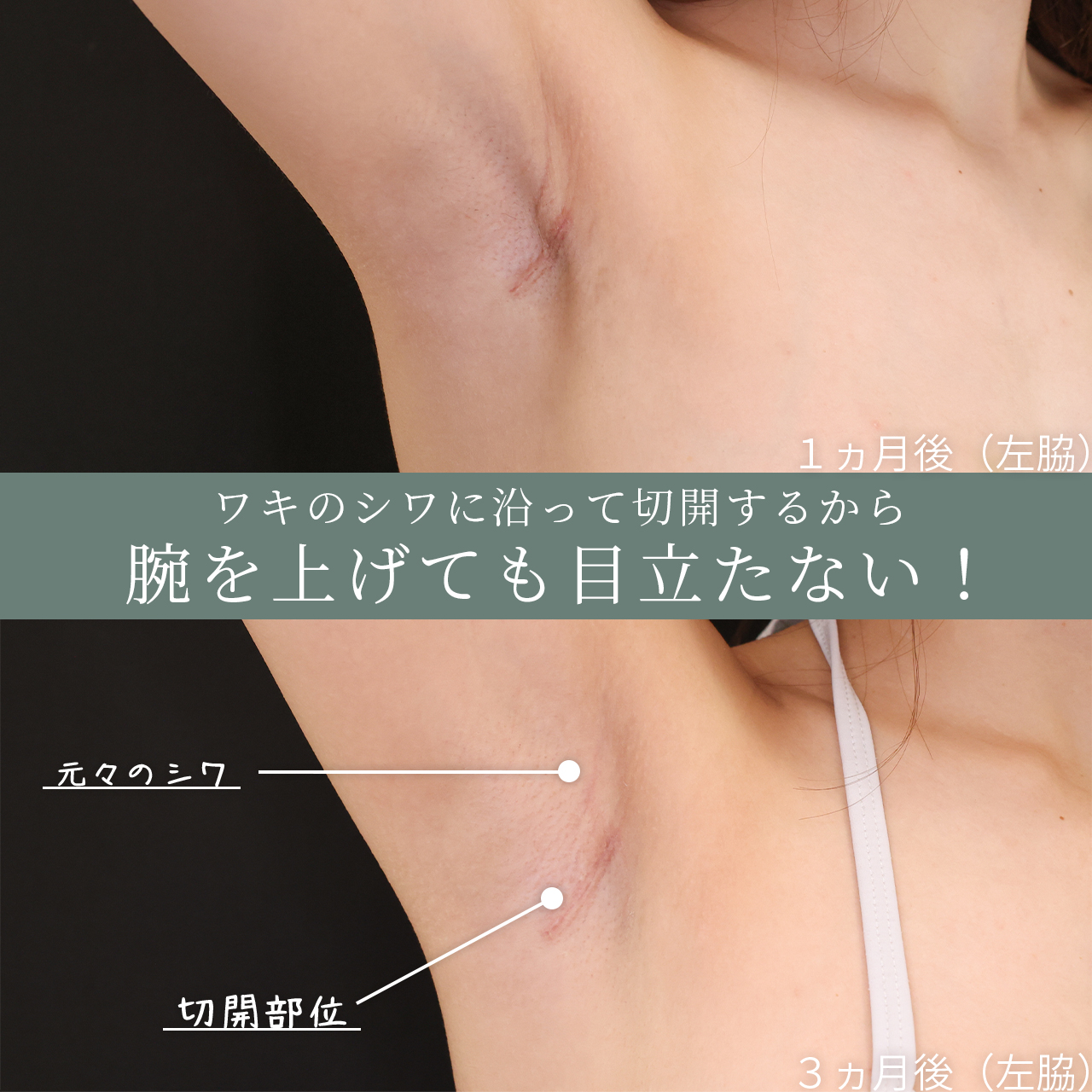 シリコンバッグ豊胸（人工乳腺バッグ）/脂肪注入豊胸（コンデンスリッチ・ピュアグラフト・１day脂肪豊胸）の症例写真 施術前後 