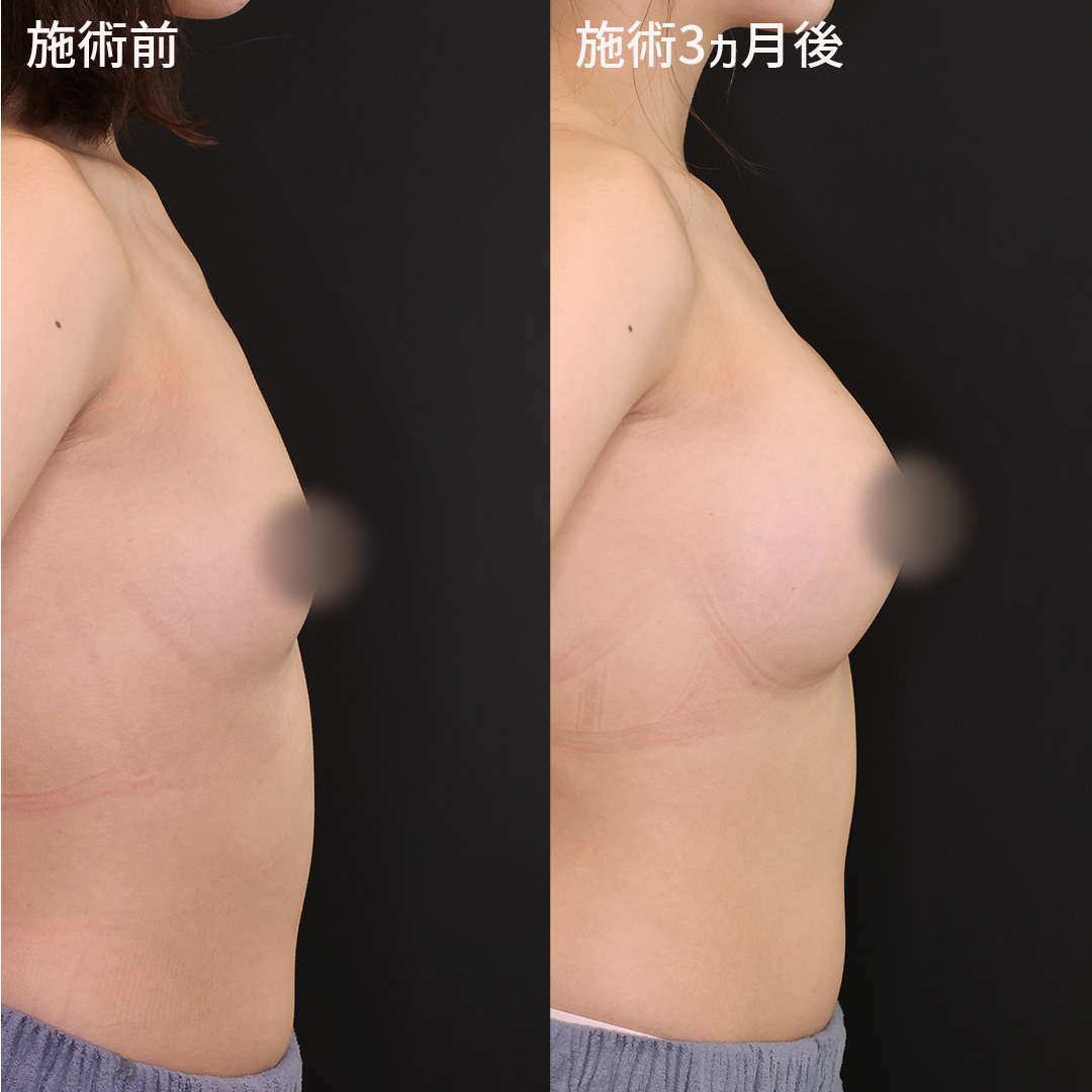 シリコンバッグ豊胸（人工乳腺バッグ）/脂肪注入豊胸（コンデンスリッチ・ピュアグラフト・１day脂肪豊胸）の症例写真 施術前後 