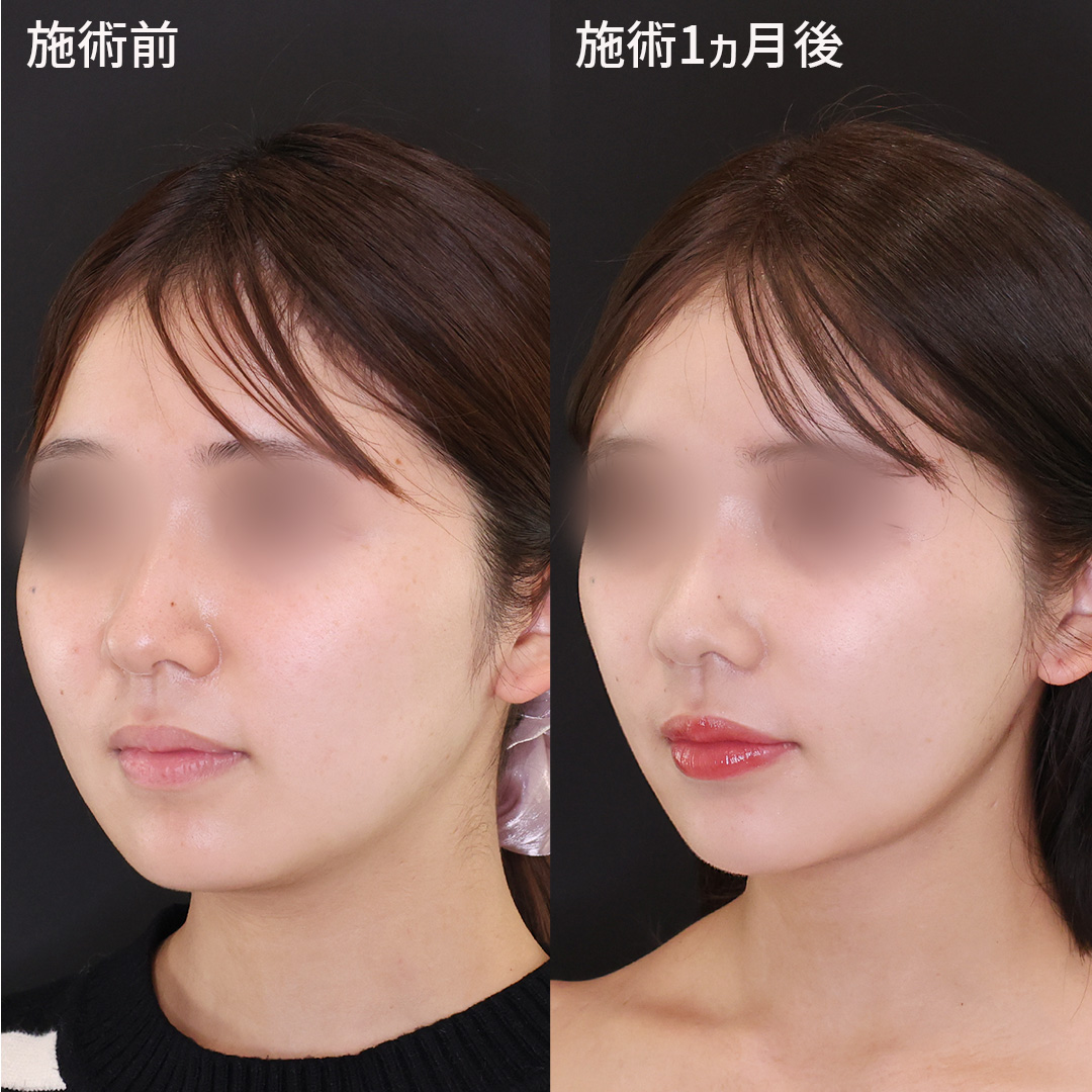 バッカルファット除去/ジョールファット除去/顎下の脂肪吸引の症例写真 施術前後 