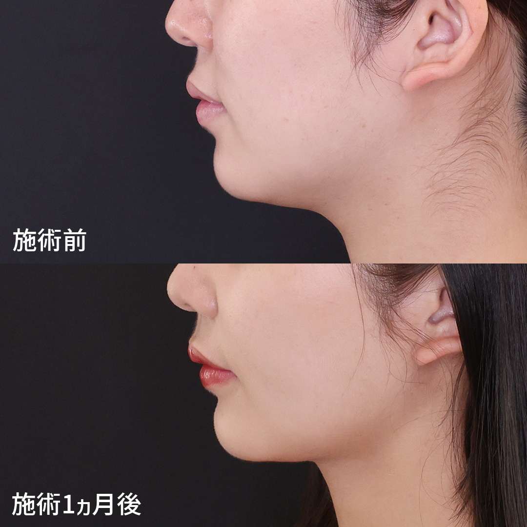 バッカルファット除去/ジョールファット除去/顎下の脂肪吸引の症例写真 施術前後 
