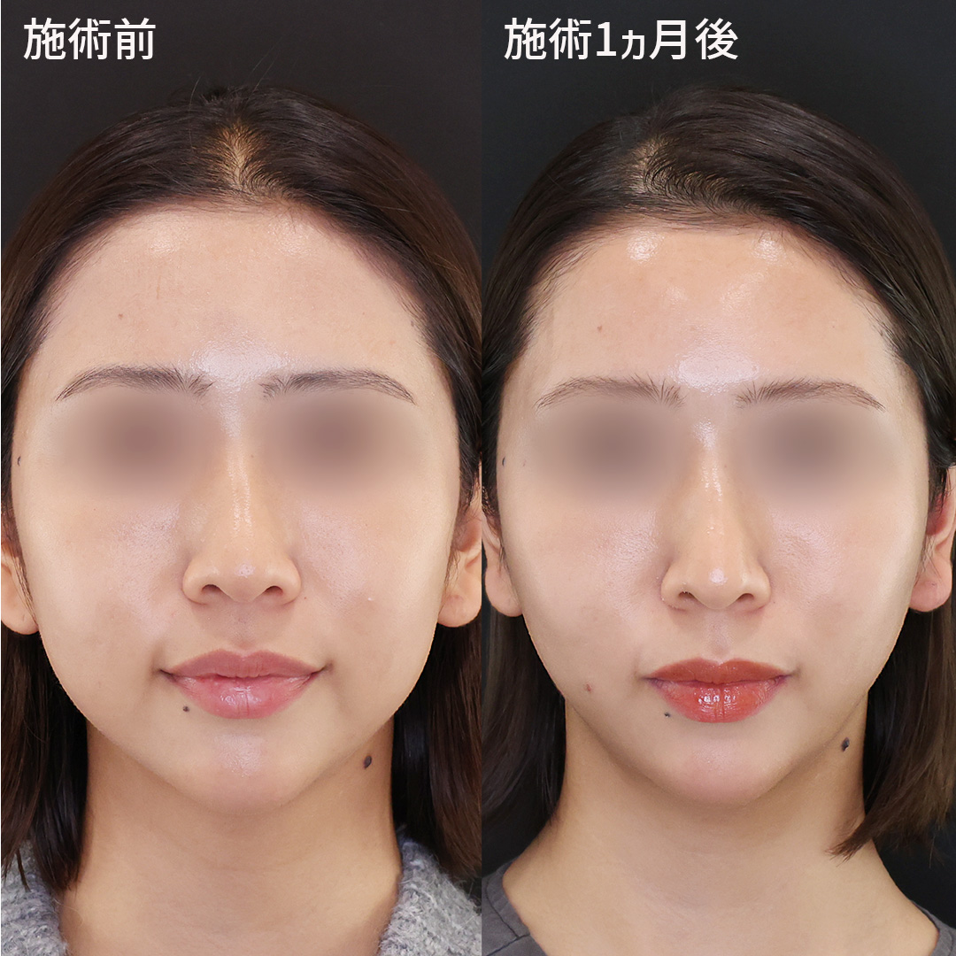 小顔から超小顔に。【ツヤ肌コラーゲンリフト®極】の驚きの効果！！