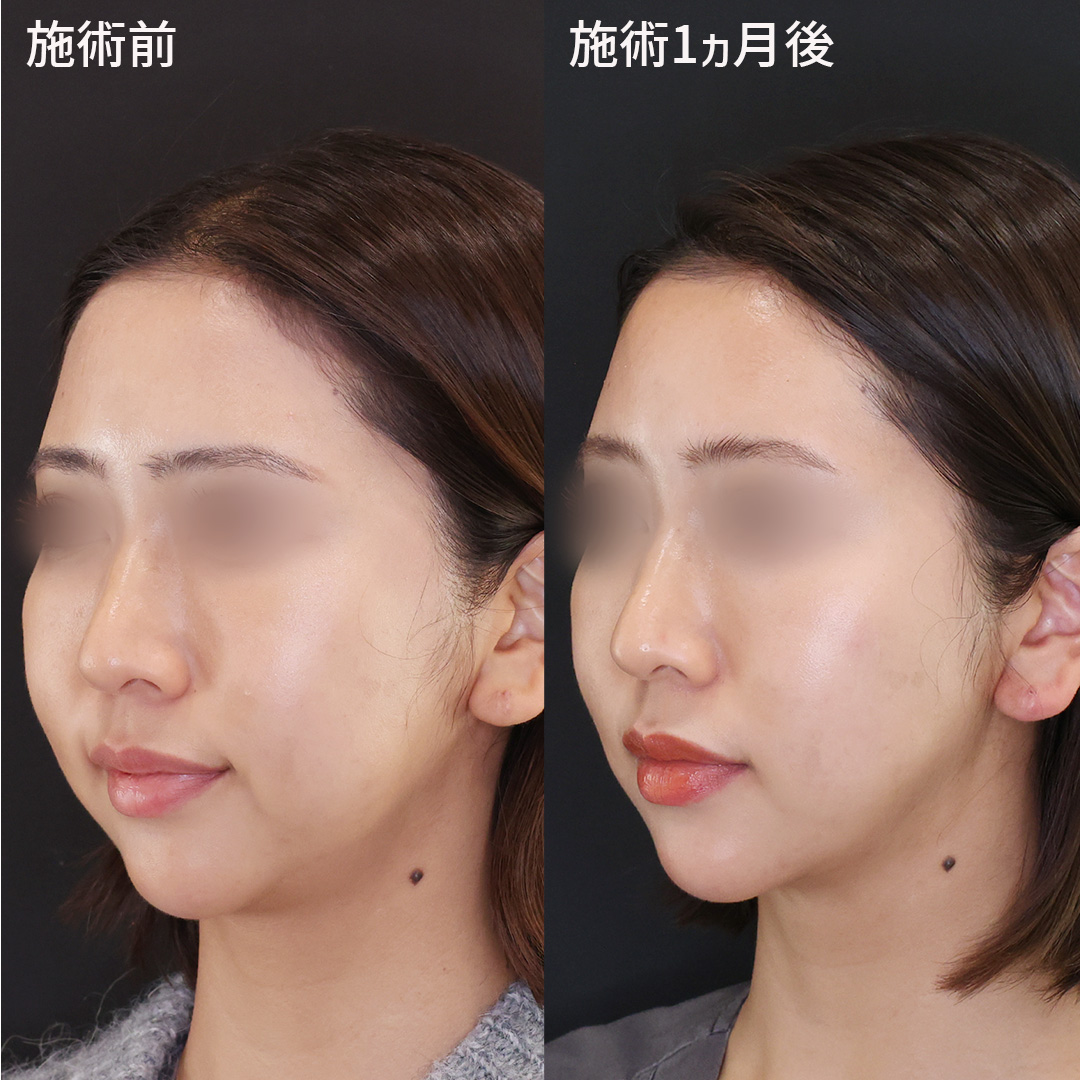 TAC式 ツヤ肌コラーゲンリフト®の症例写真 施術前後 